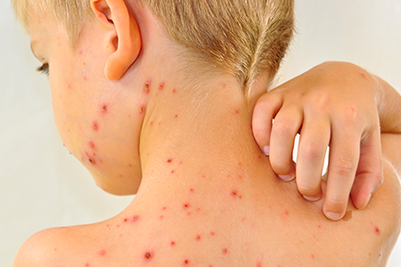 Cách phòng tránh bệnh Sốt xuất huyết an toàn và hiệu quả nhất :)