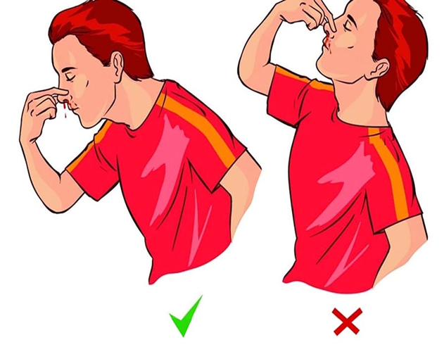 Kỹ năng sơ cứu khi bị chảy máu cam